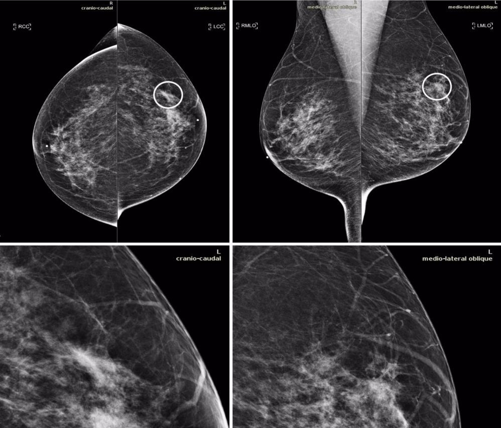 Herramienta de inteligencia artificial mejora la detección del cáncer de mama en la mamografía.